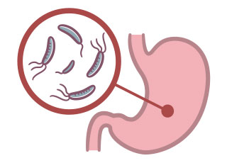 ピロリ菌感染